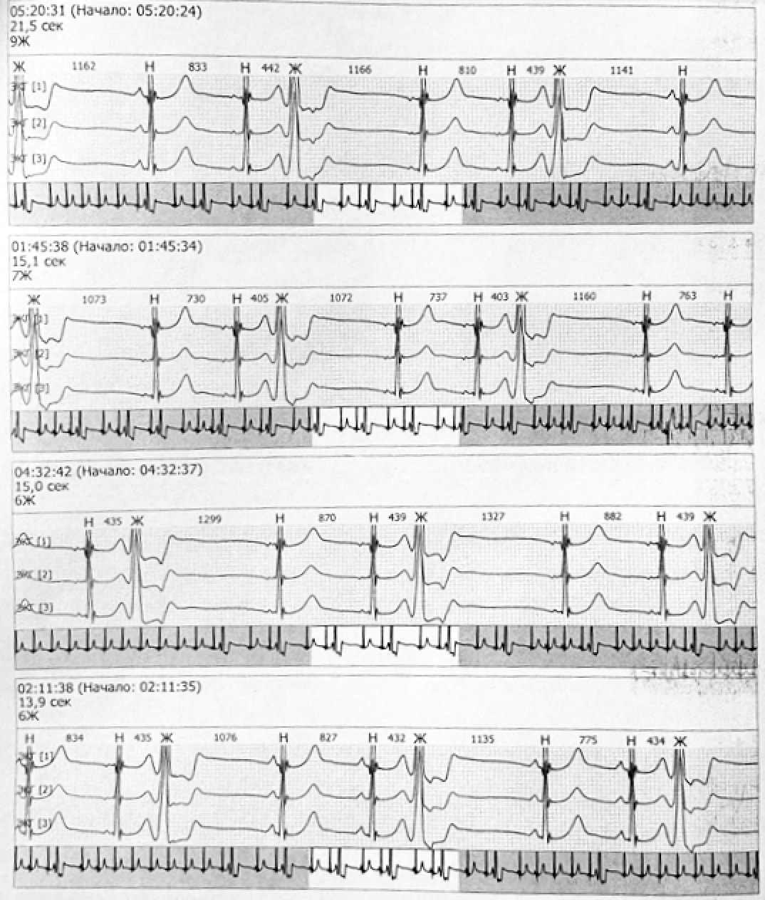 Показатели ХМЭКГ