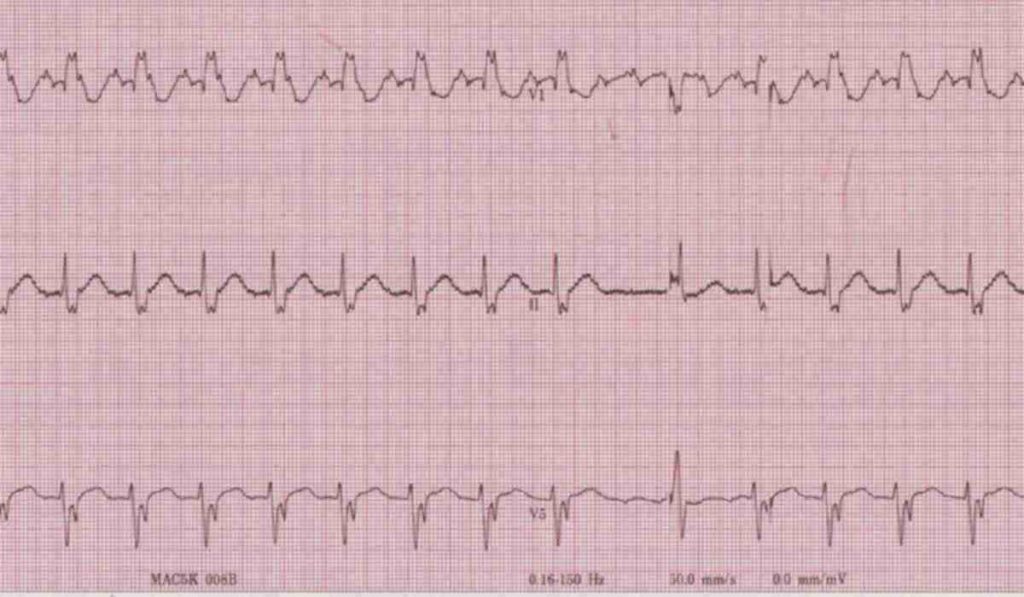 Калькулятор коригованого інтервалу QT